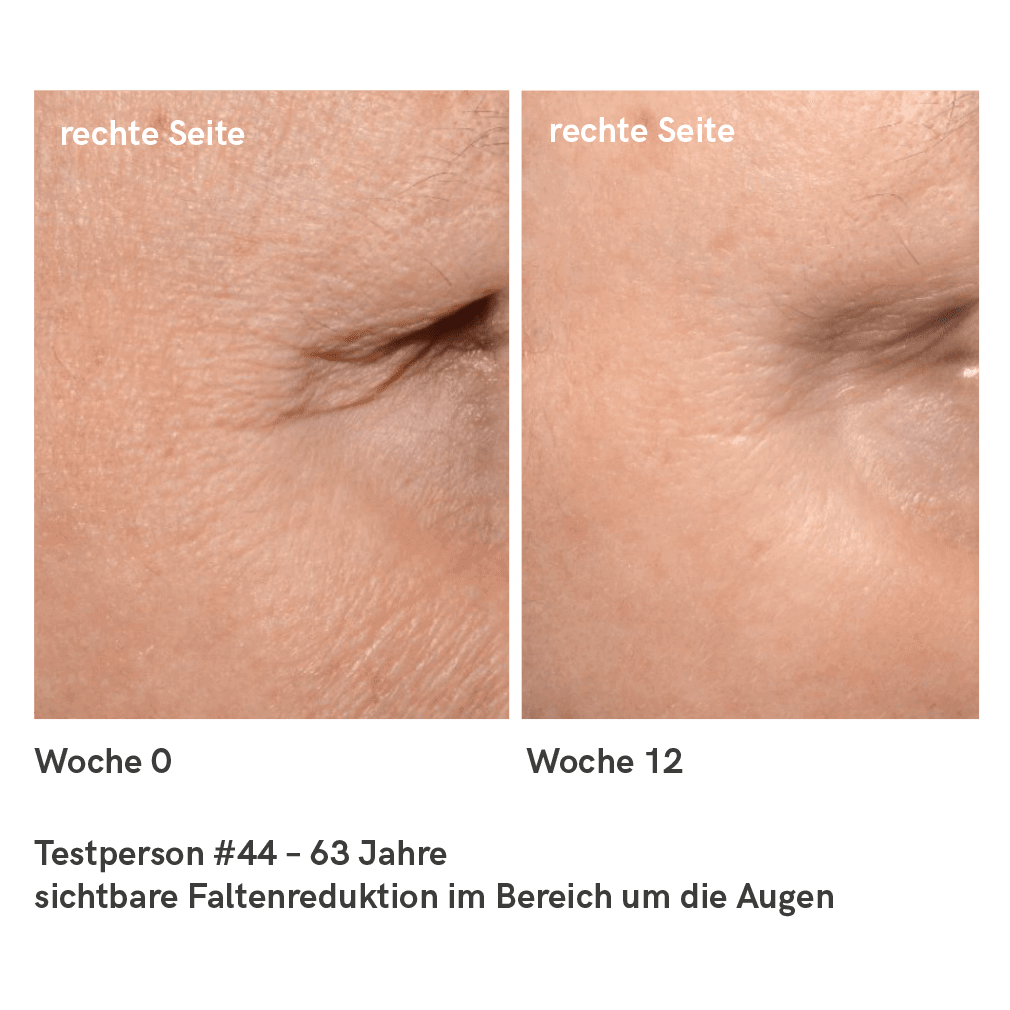 Vorher-Nachher-Bild, das die Effektivität von SkinHydral⁺ bei der Verbesserung der Hautqualität veranschaulicht.